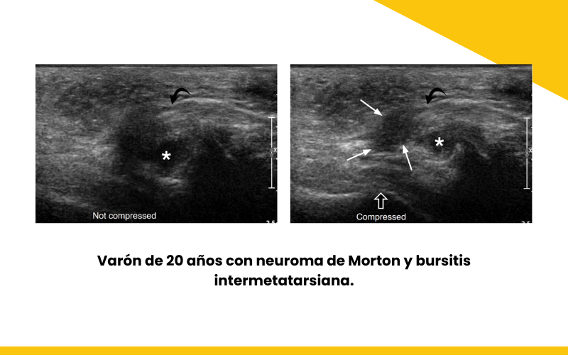 1. Bursitis intermetatarsiana y ecografia tempo formacion.png